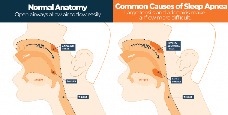 sleep-apnea-in-children-signs-symptoms-and-treatments