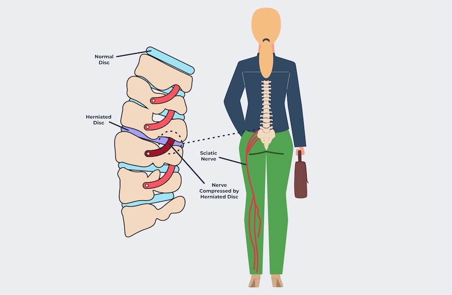 An illustration of how a herniated disc causes back pain